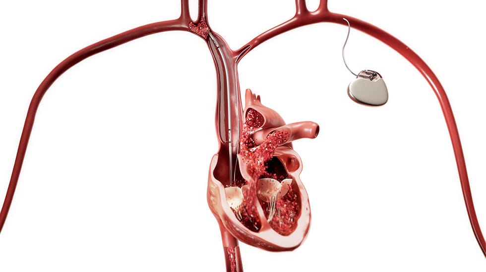 Clinical illustration of the Philips Bridge Plus balloon in use