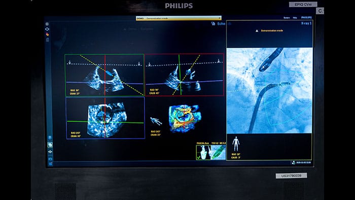 Philips DeviceGuide with EchoNavigator 5 Screen -  