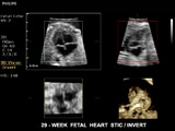 ClearVue 650 29 week Fetal heart STIC - Invert