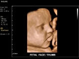 ClearVue 650 "Fetal face"