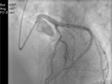 Coronary angiogram with Allura Clarity using 50% less the X-ray  as normally used with Allura Xper