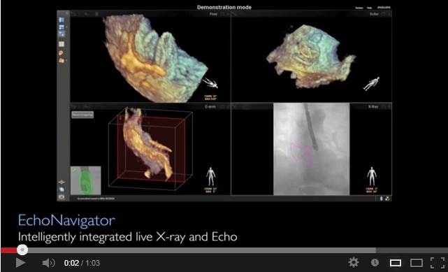 Philips EchoNavigator Explanation