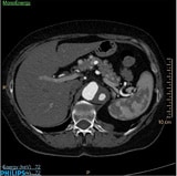 Conventional CT image lesions pancreas review at 72keV