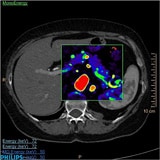 Spectral CT image lesions pancreas review with Effective Z