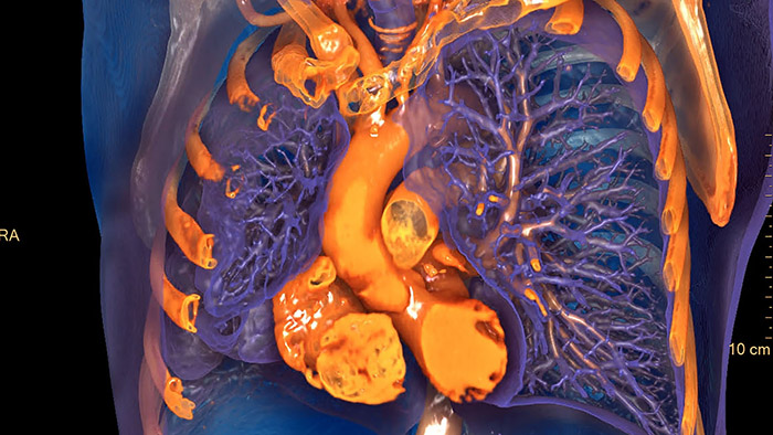 Philips and radiology go virtual and remote at RSNA 2020