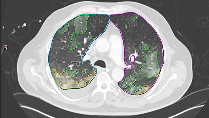 Philips introduces next generation of Advanced Visualization Workspace &ndash; IntelliSpace Portal 12 &ndash; with AI capabilities at RSNA 2020